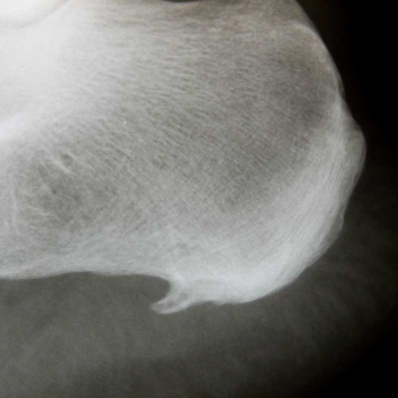Röntgenbild des Fersensporns zur Diagnose und Behandlungsplanung bei Fersensporn.
