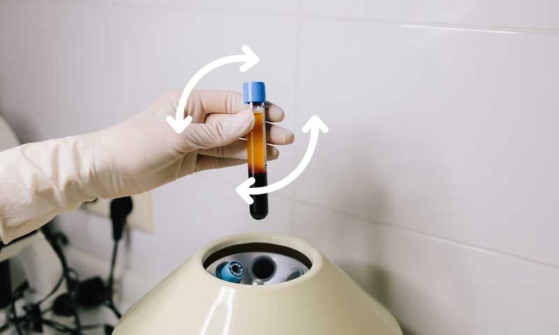 wie-funktioniert-platelet-rich-plasma-prp