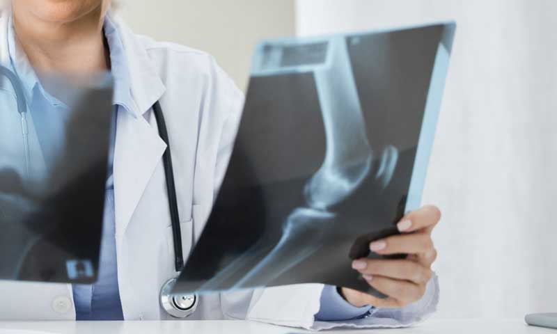 Wie wird Arthrose festgestellt?