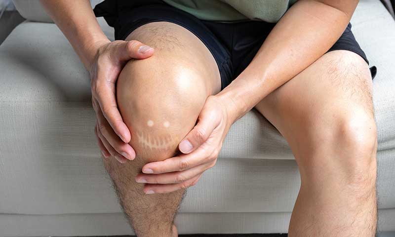 Verheilte Hautstelle am Knie mit lächelnder Form als positives Symbol für den Heilungsverlauf