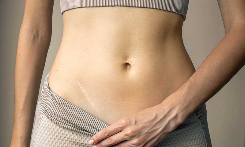 Operationsnarbe am Bauch nach chirurgischem Eingriff im Rahmen der Wundheilung